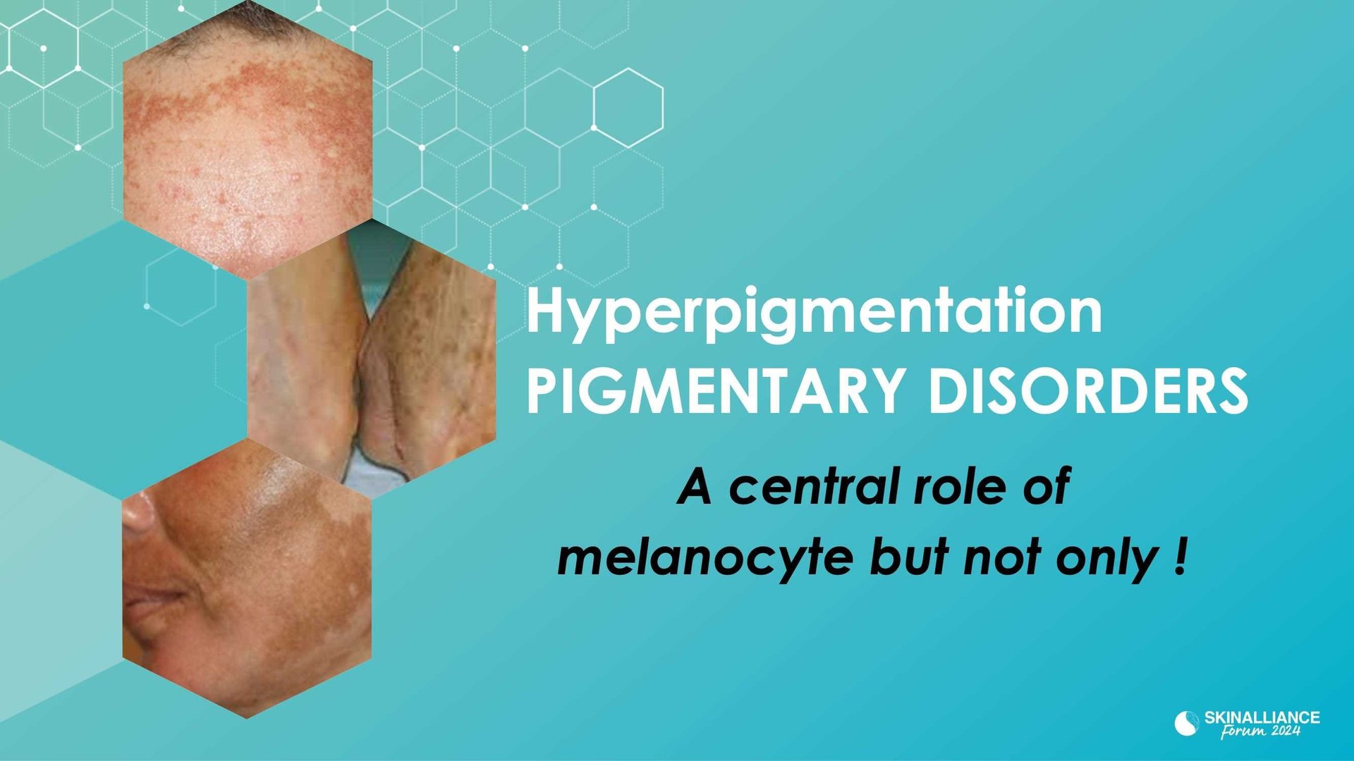New insights in the physiopathology of hyperpigmentation and clinical impact