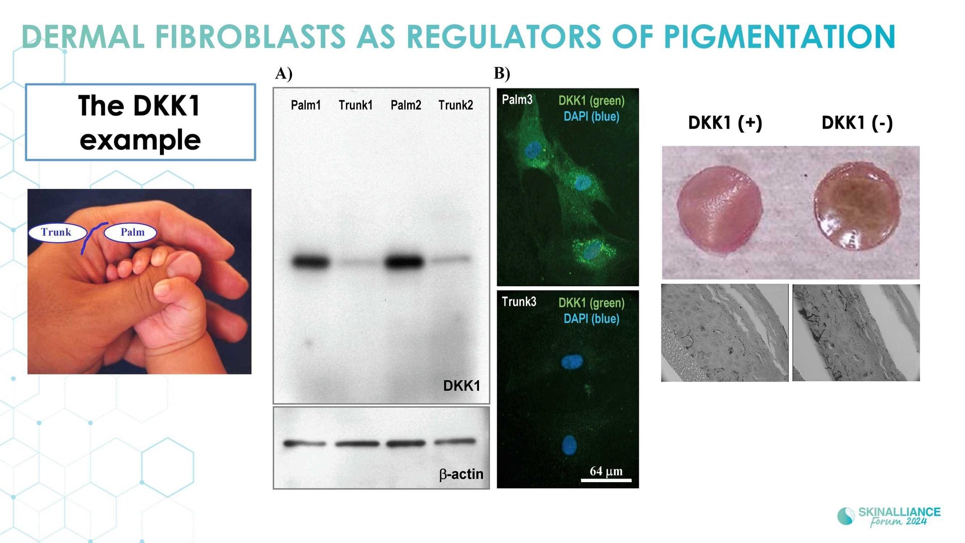 New insights in the physiopathology of hyperpigmentation and clinical impact