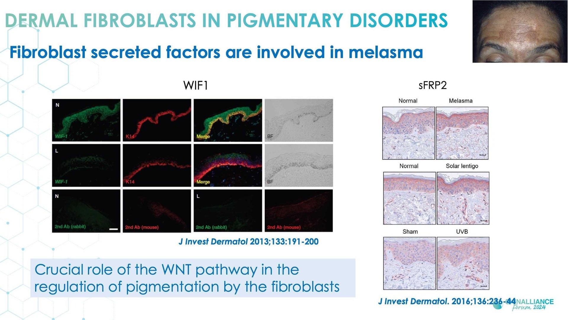 New insights in the physiopathology of hyperpigmentation and clinical impact