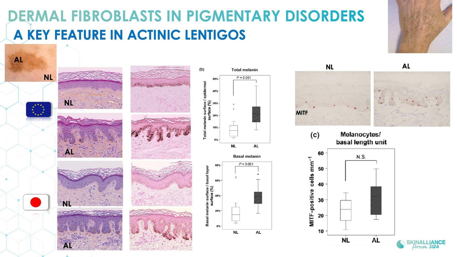 New insights in the physiopathology of hyperpigmentation and clinical impact