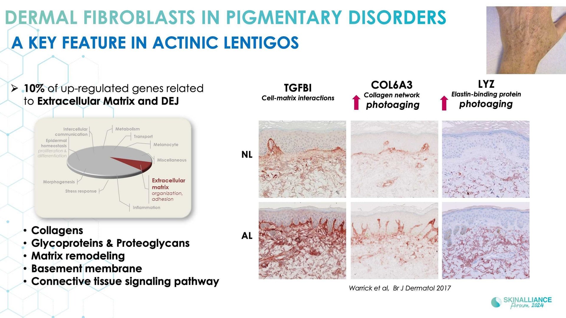 New insights in the physiopathology of hyperpigmentation and clinical impact