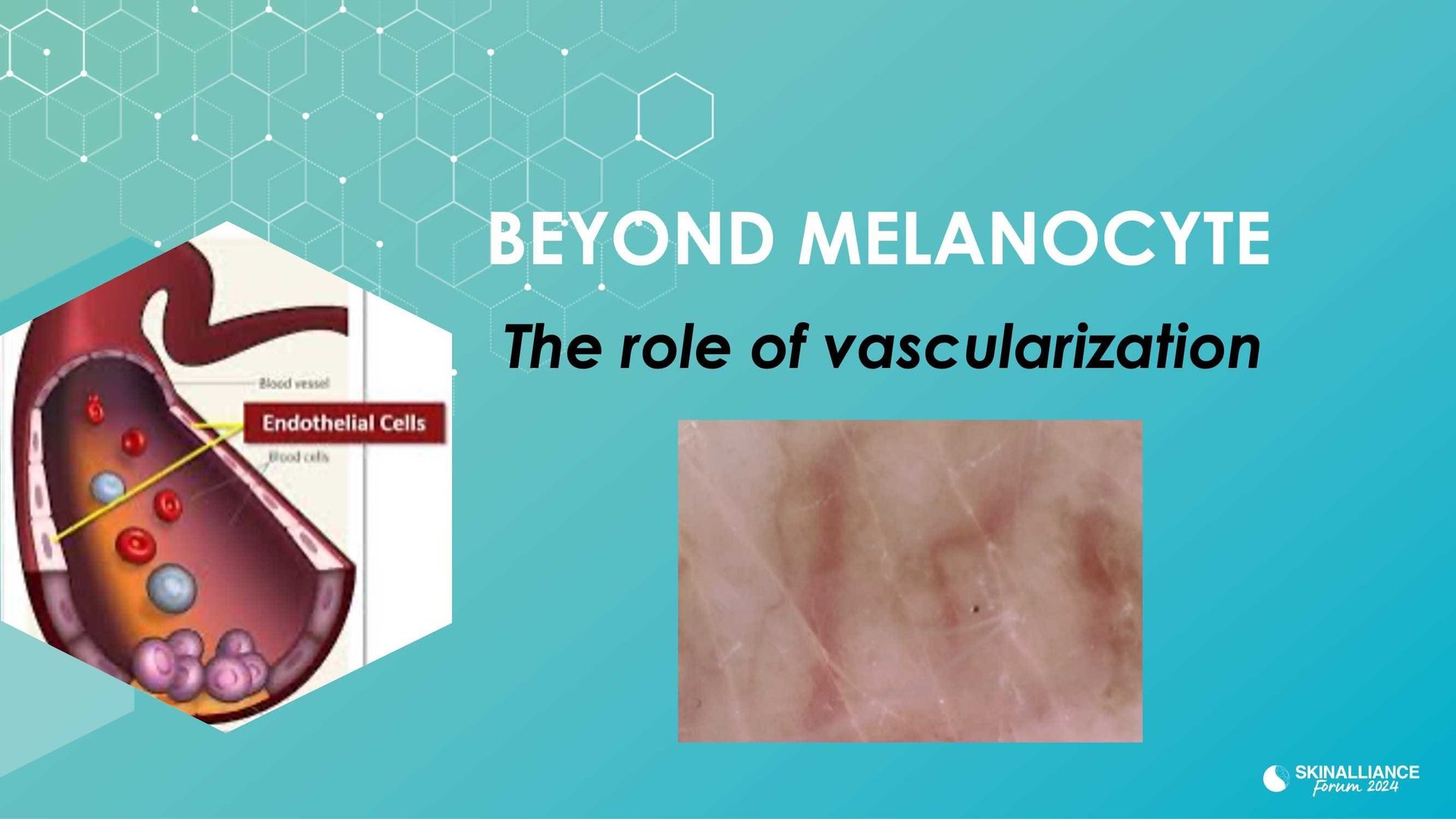 New insights in the physiopathology of hyperpigmentation and clinical impact