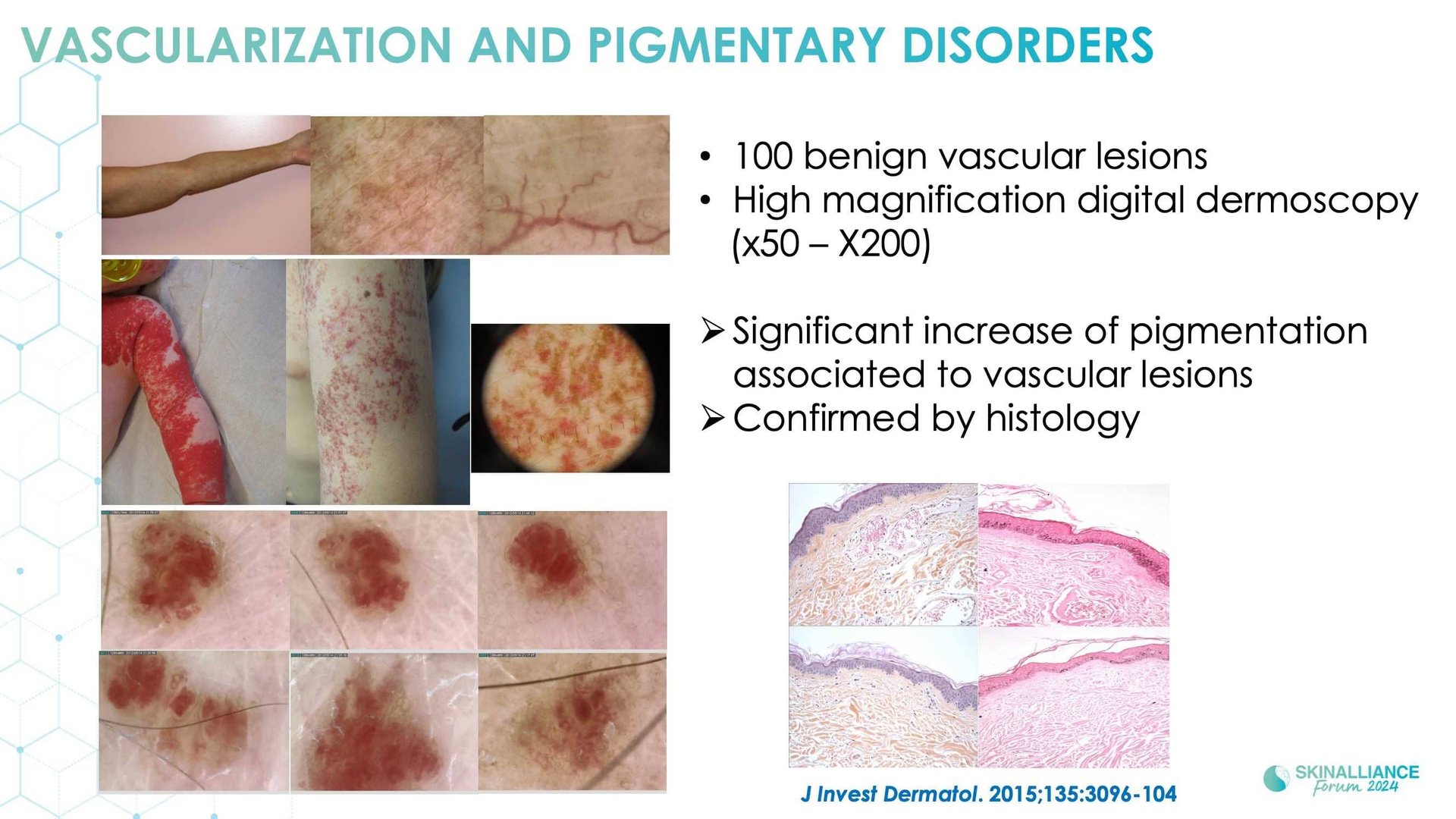 New insights in the physiopathology of hyperpigmentation and clinical impact