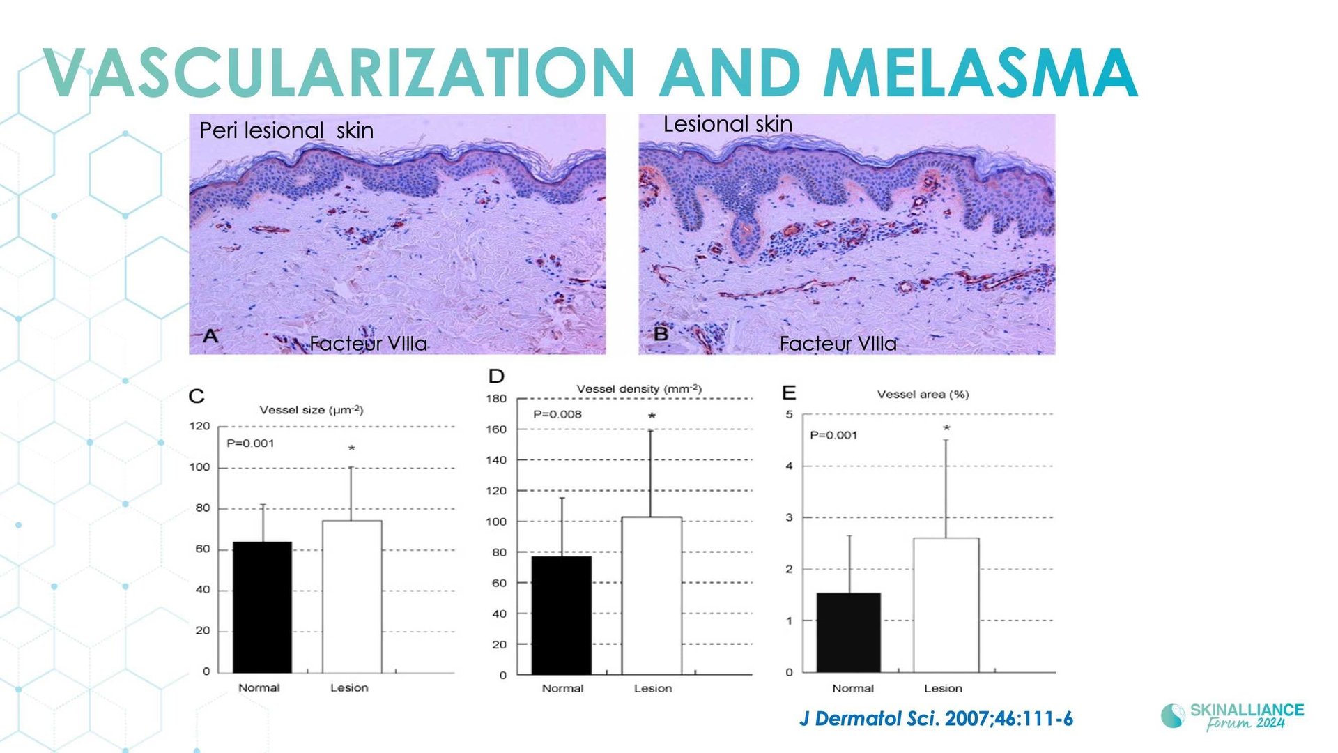 New insights in the physiopathology of hyperpigmentation and clinical impact