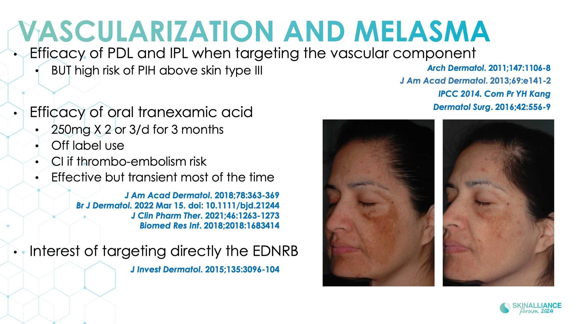 New insights in the physiopathology of hyperpigmentation and clinical impact
