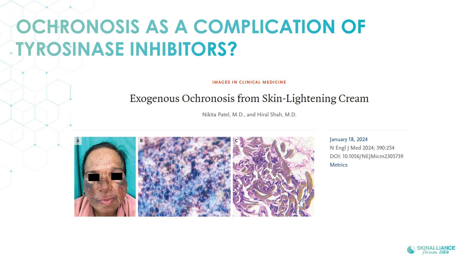 New topical agent for hyperpigmentation management