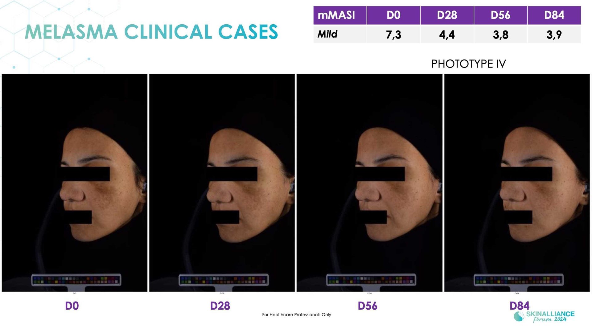 New topical agent for hyperpigmentation management