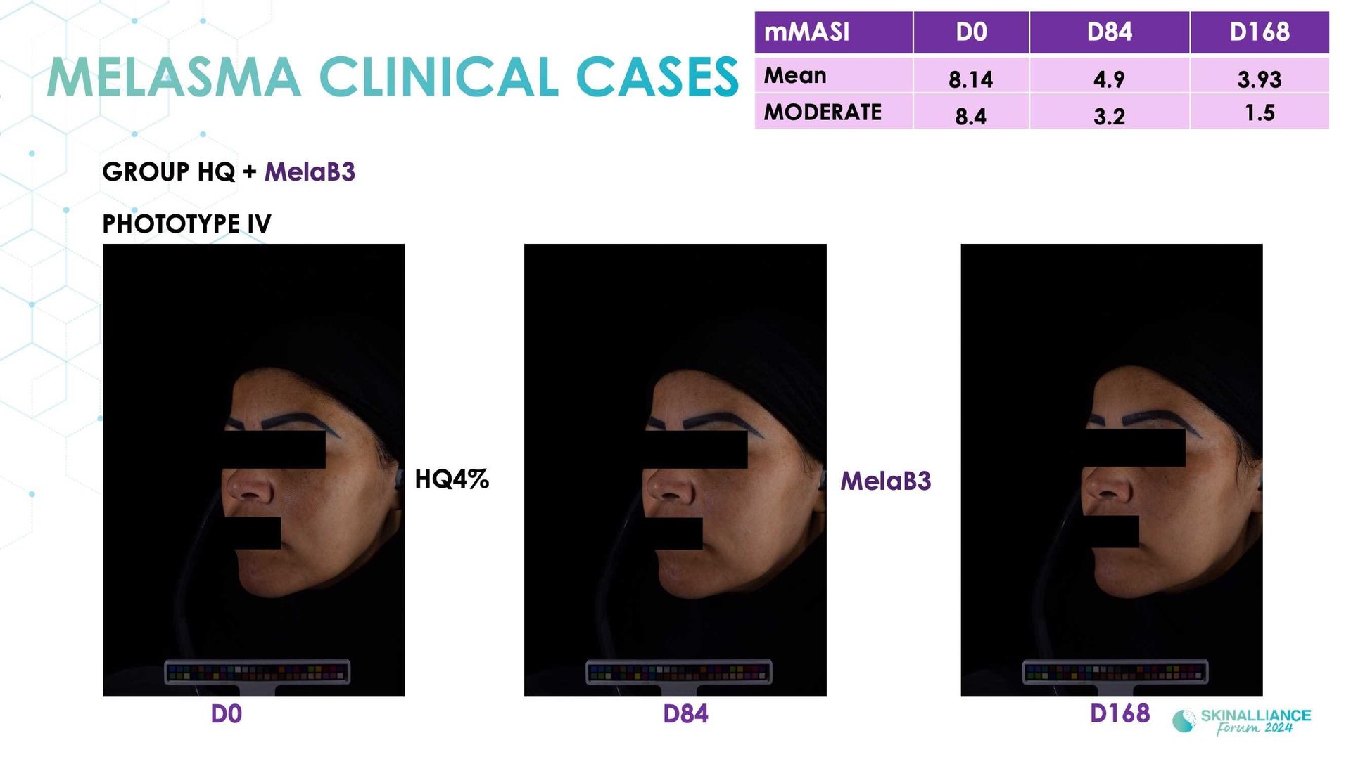 New topical agent for hyperpigmentation management