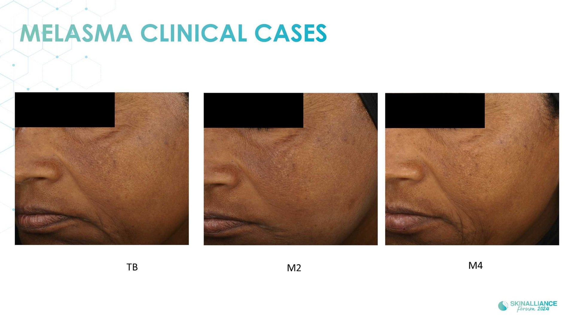 New topical agent for hyperpigmentation management