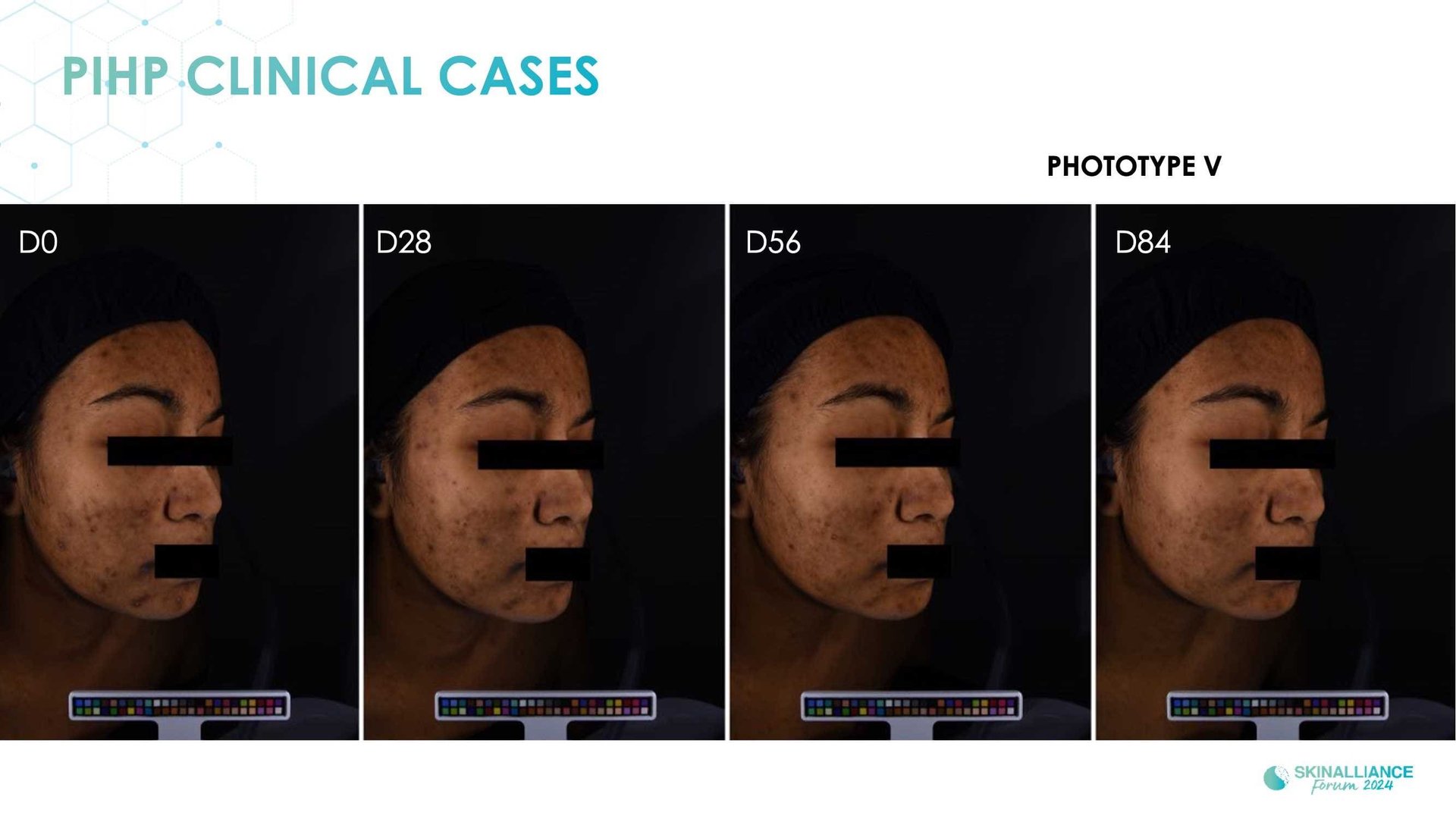 New topical agent for hyperpigmentation management