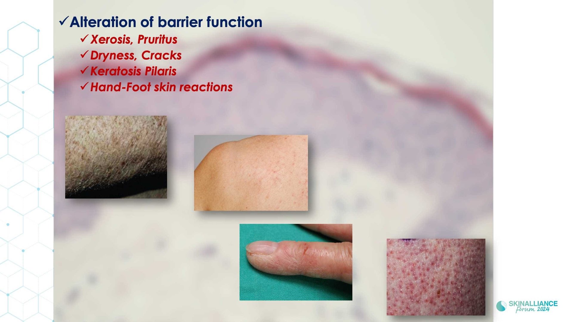 Anticancer-related skin toxicities management of adverse event