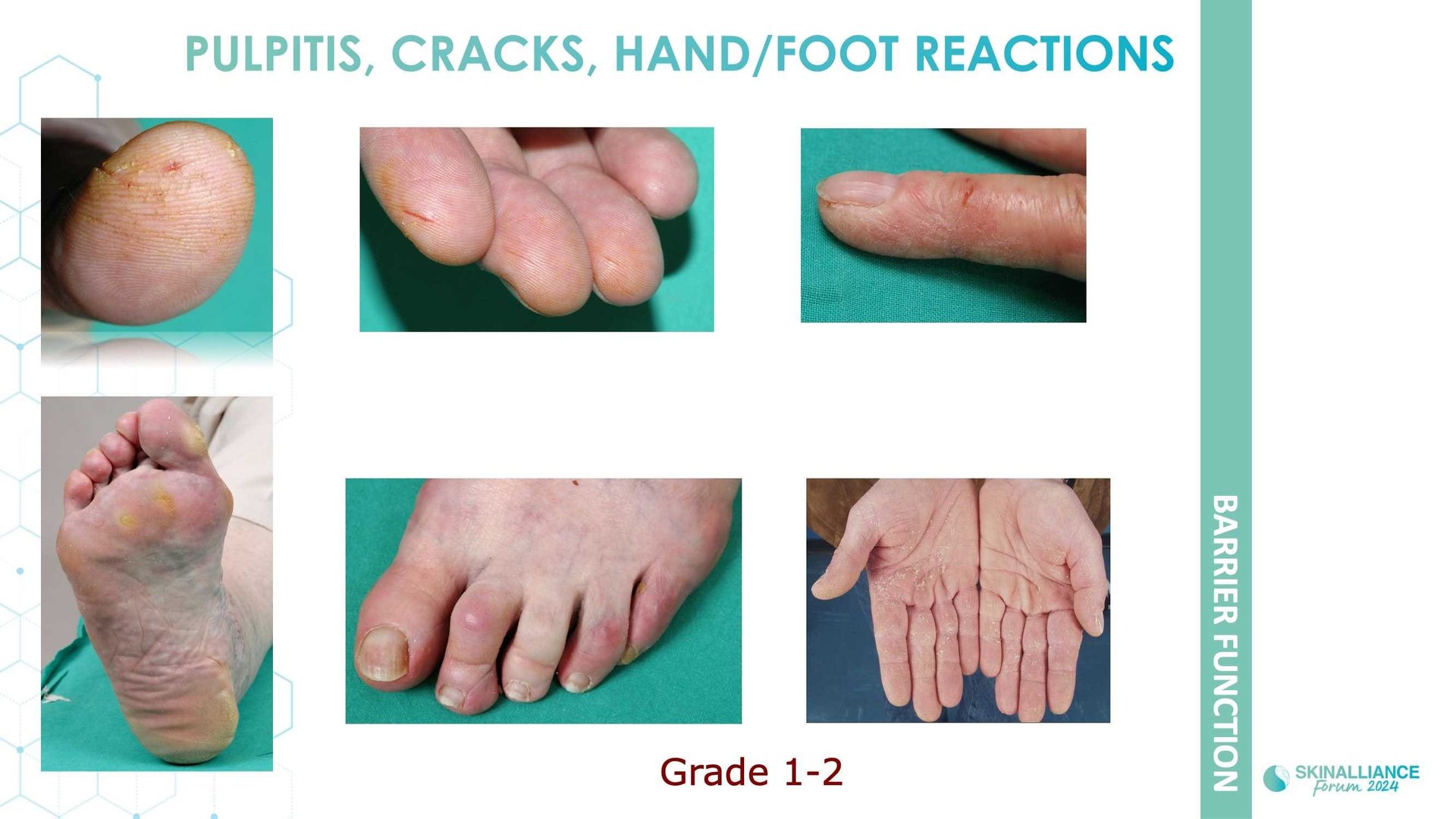 Anticancer-related skin toxicities management of adverse event