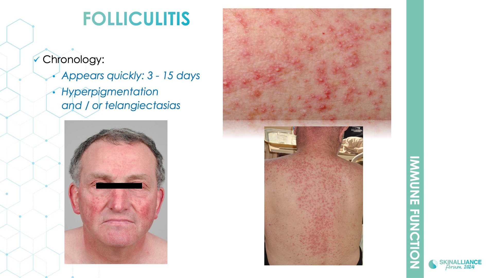 Anticancer-related skin toxicities management of adverse event