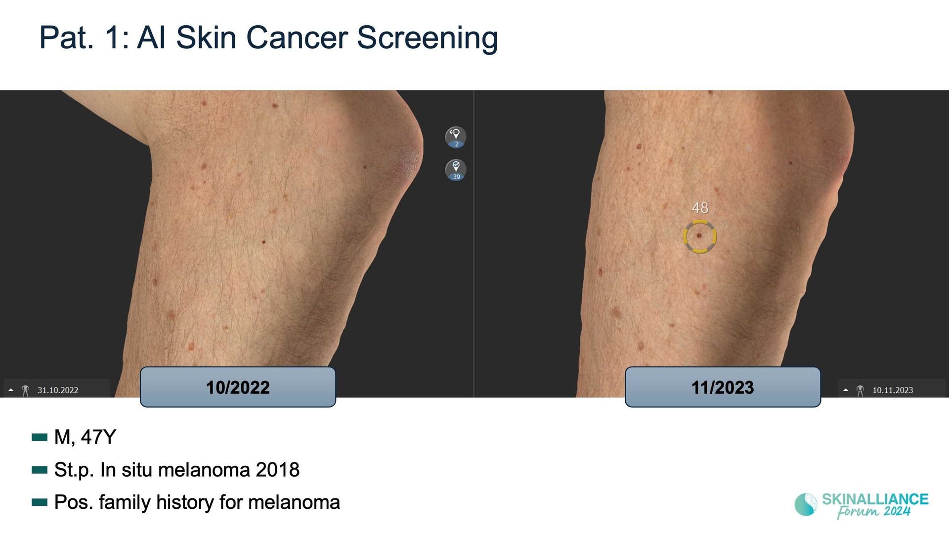 Overview of skin cancer detection devices using artificial intelligence