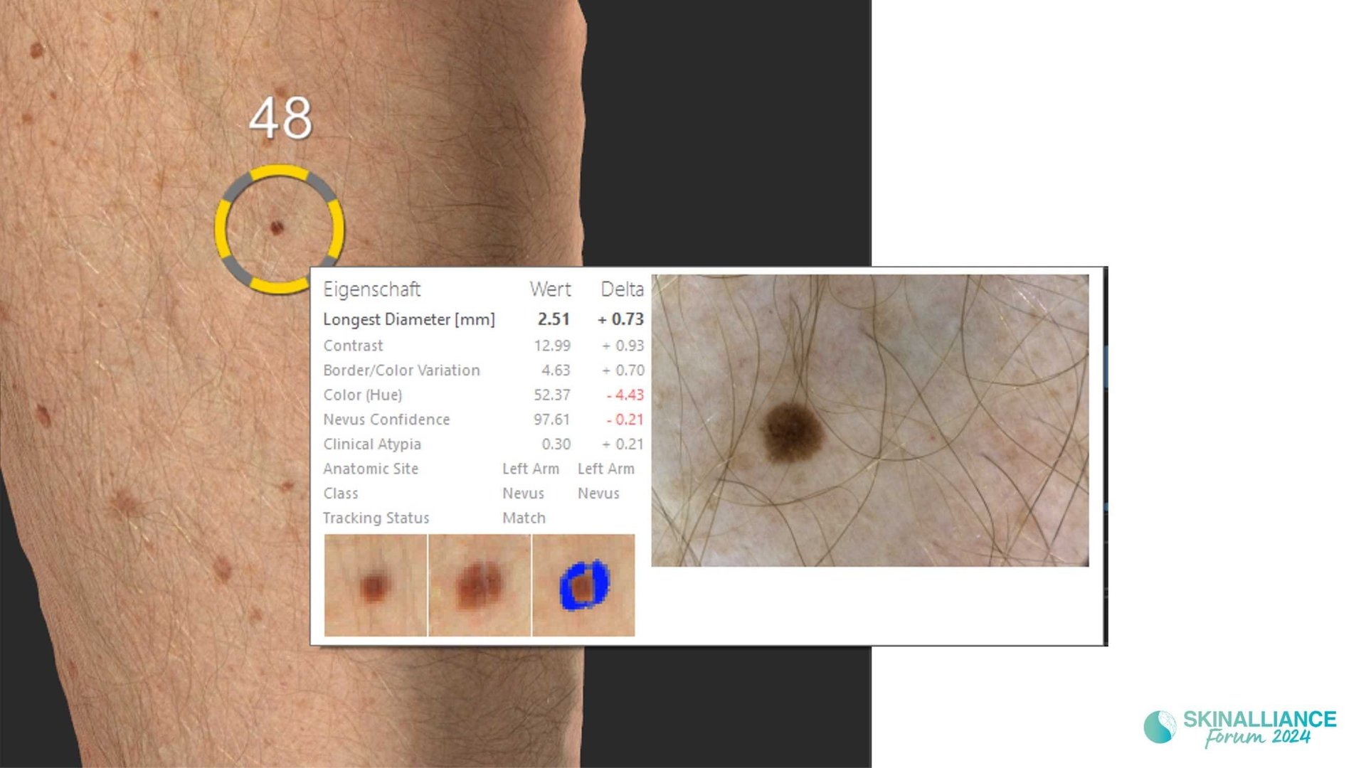 Overview of skin cancer detection devices using artificial intelligence