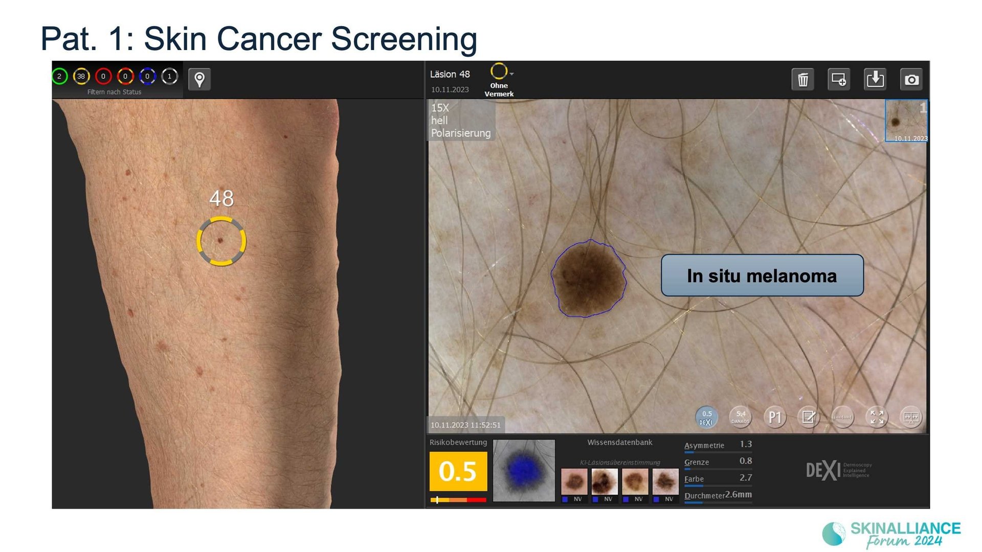 Overview of skin cancer detection devices using artificial intelligence