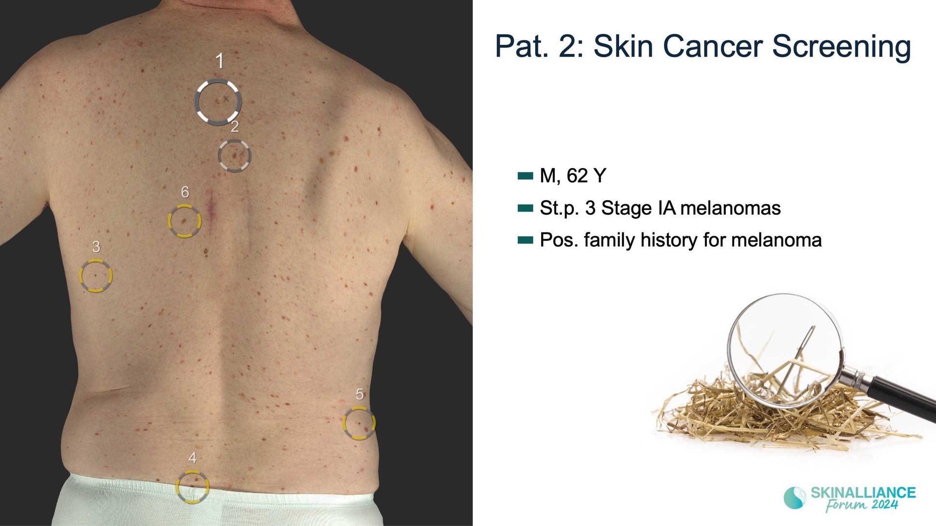 Overview of skin cancer detection devices using artificial intelligence