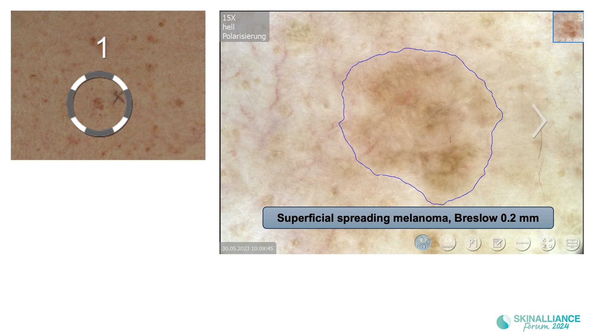Overview of skin cancer detection devices using artificial intelligence