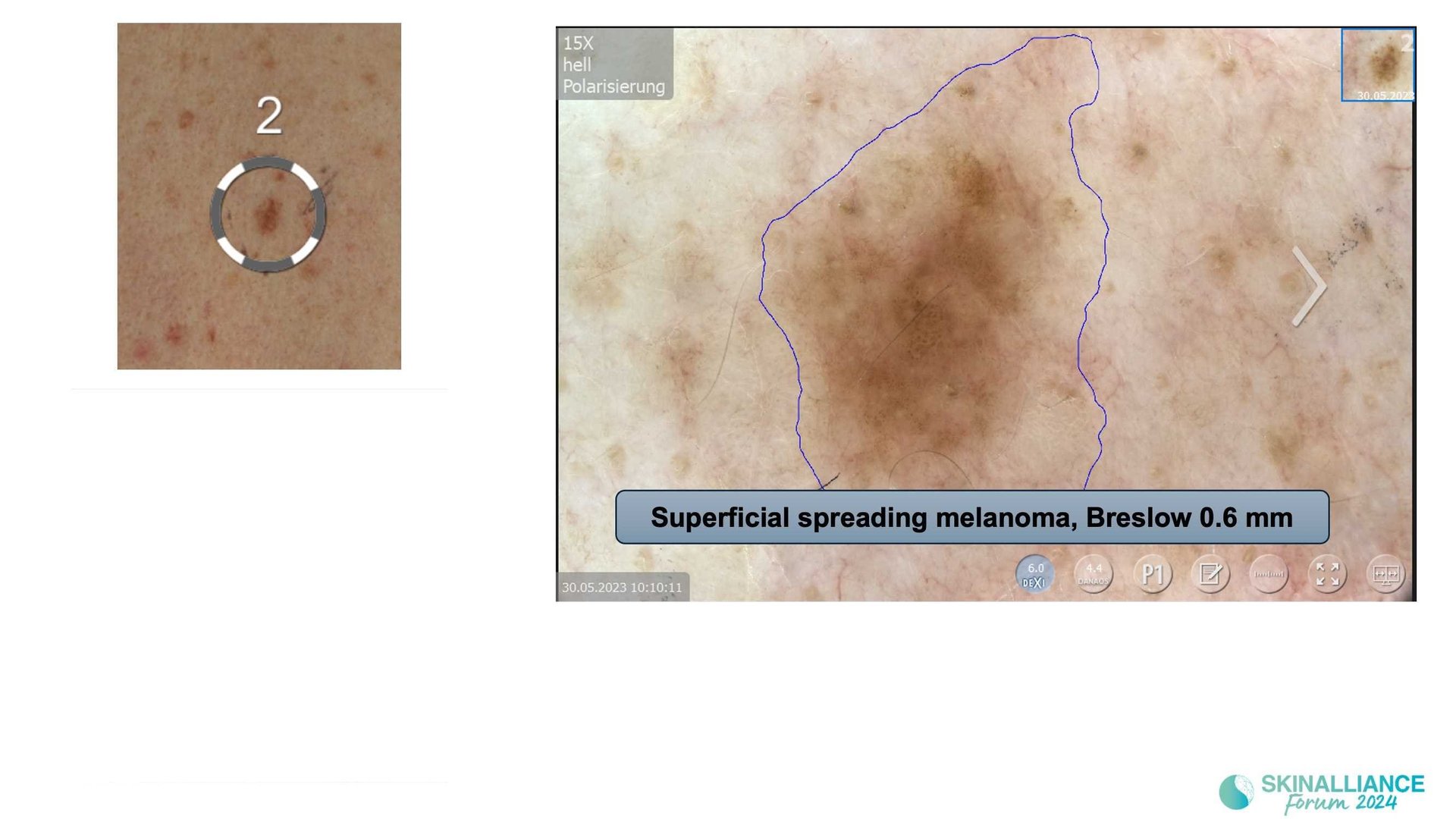 Overview of skin cancer detection devices using artificial intelligence
