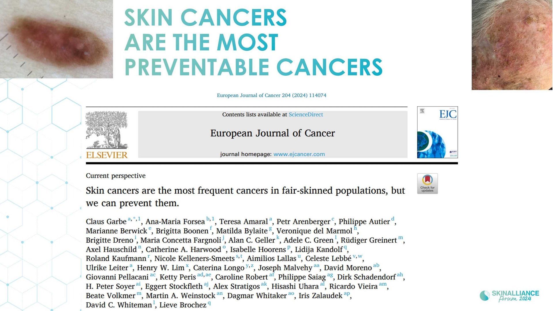 Overview of skin cancer detection devices using artificial intelligence