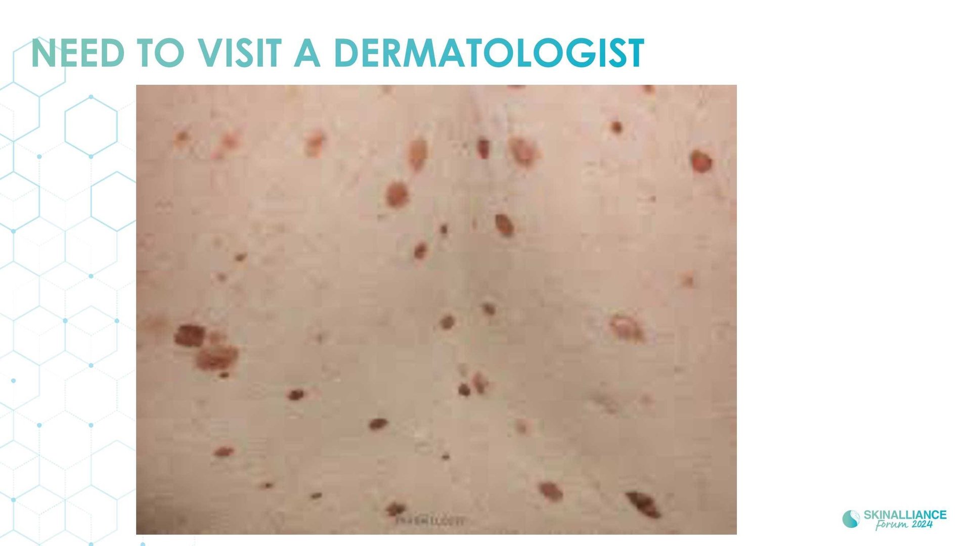 Overview of skin cancer detection devices using artificial intelligence
