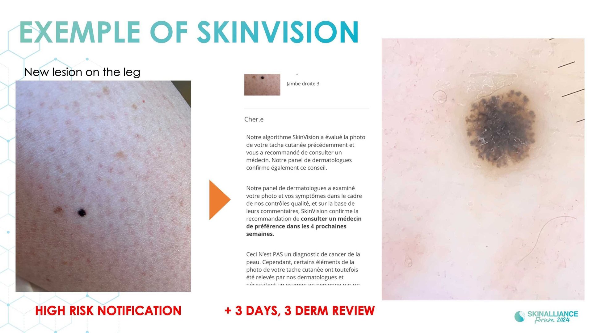 Overview of skin cancer detection devices using artificial intelligence