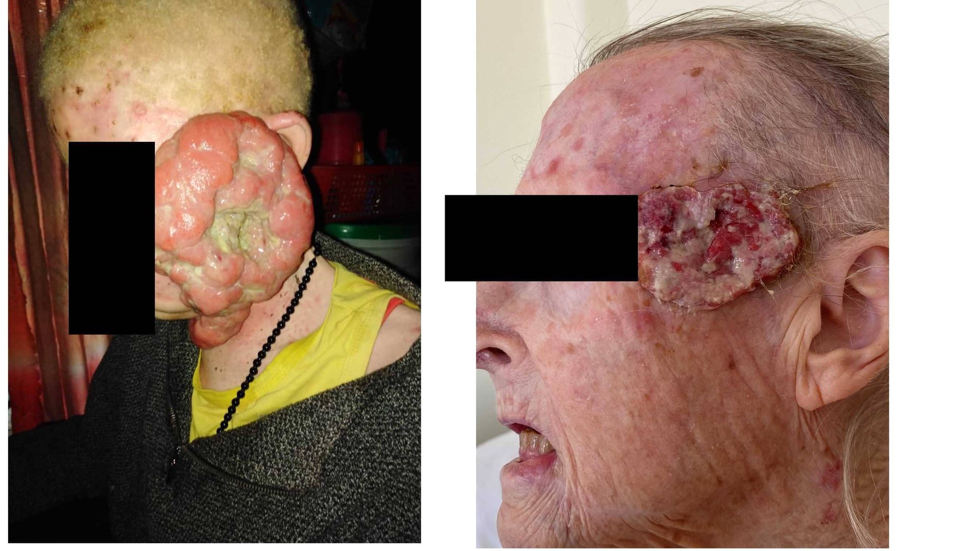 Overview on inequality of skin health access worldwide
