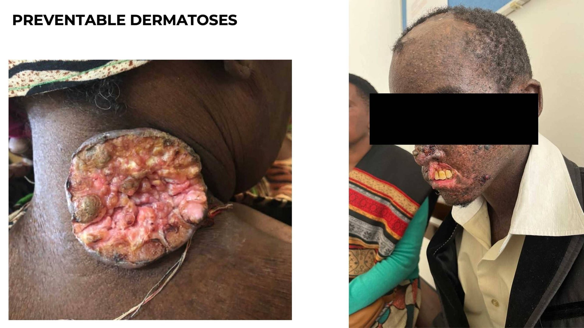 Overview on inequality of skin health access worldwide