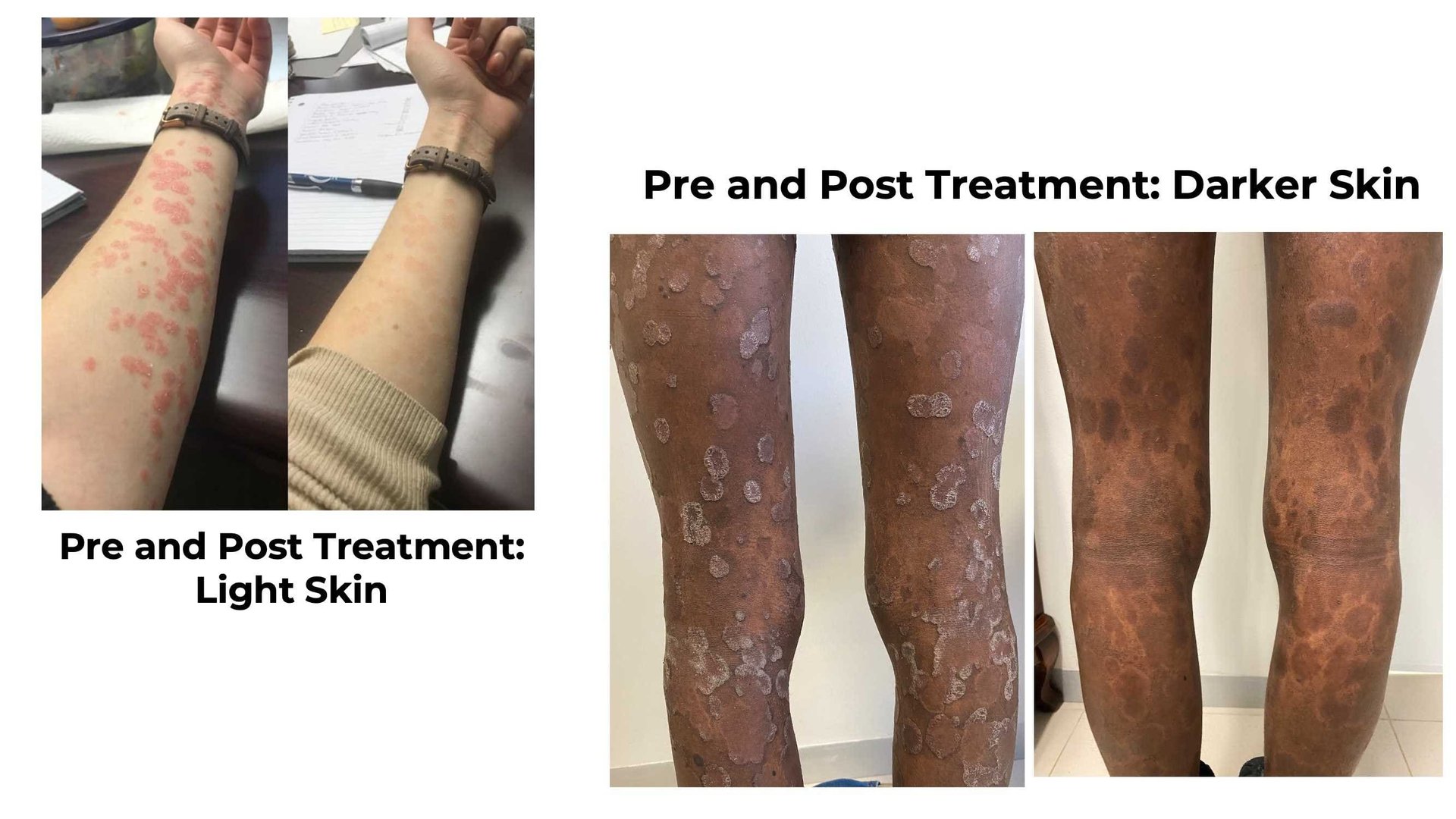 Overview on inequality of skin health access worldwide