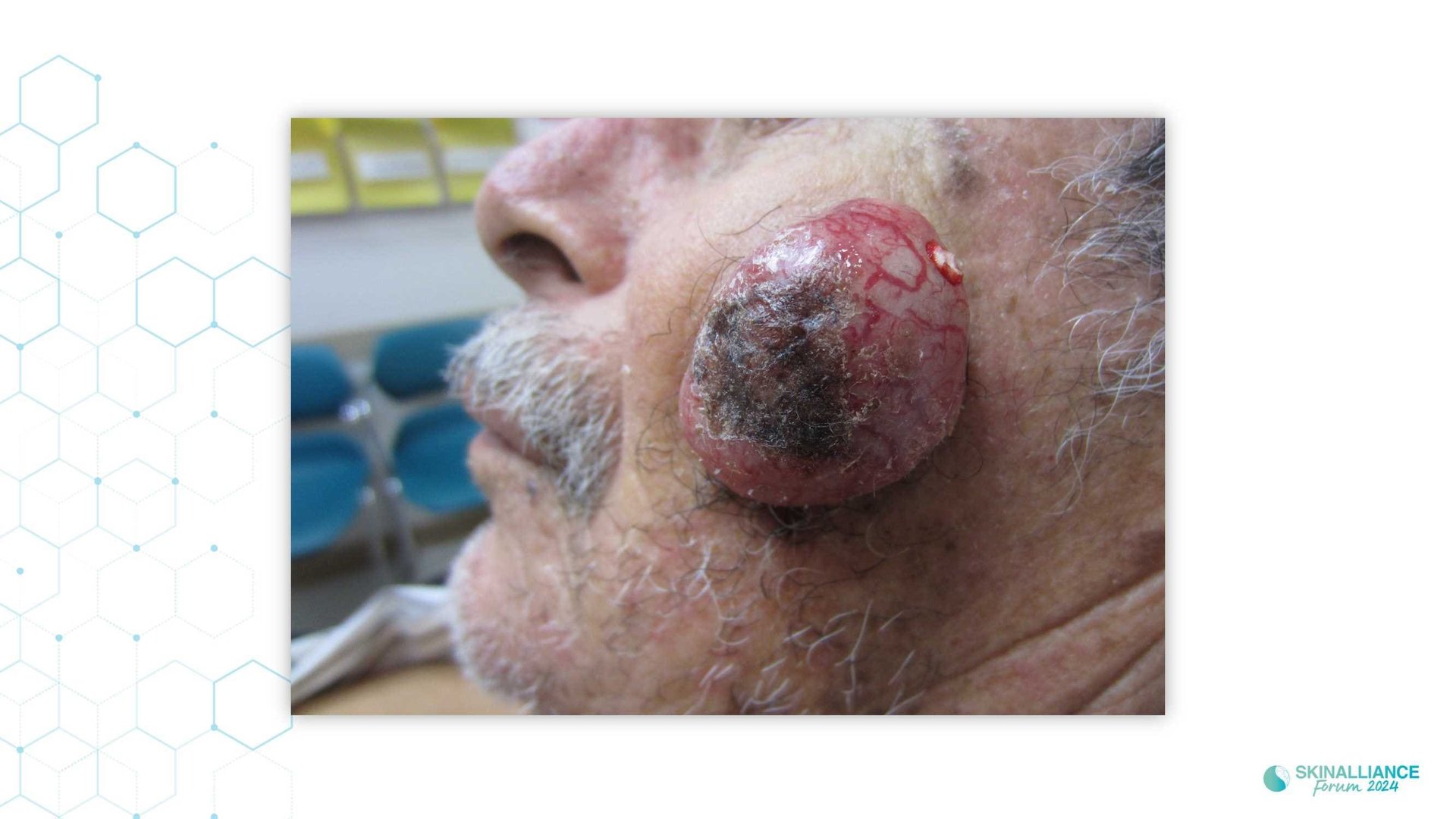 Teledermatology to support undeserved population health access