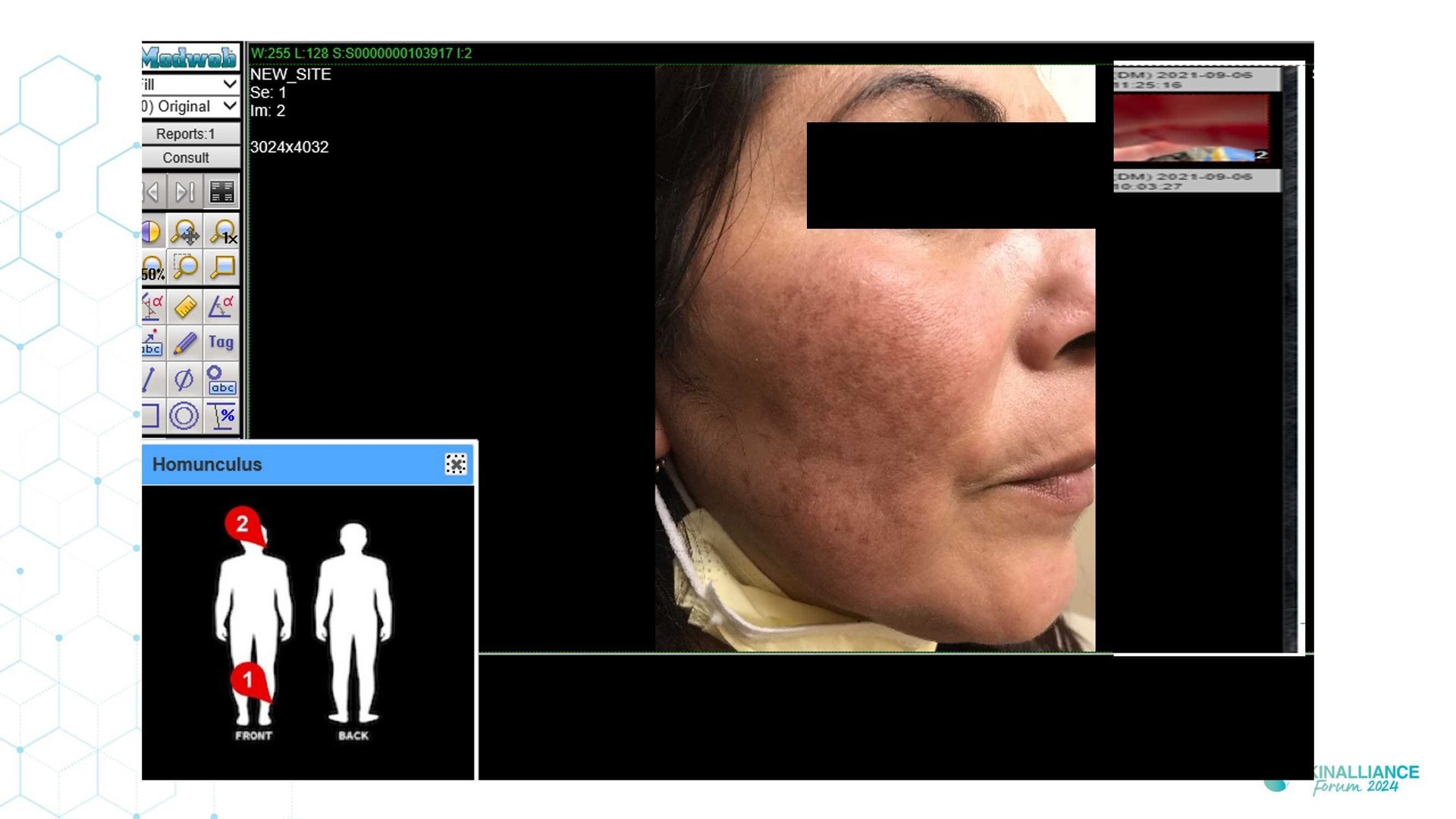 Teledermatology to support undeserved population health access