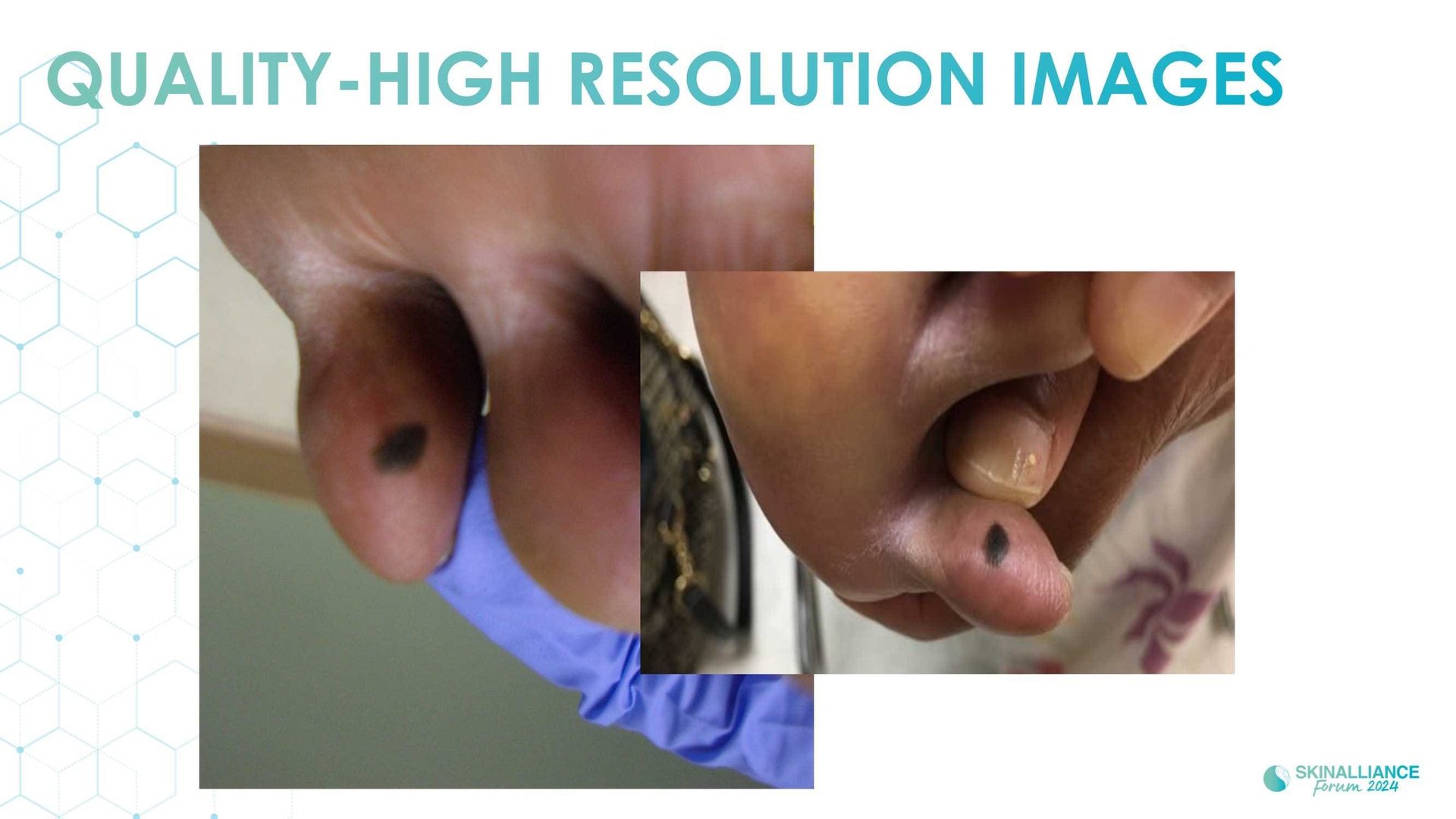 Teledermatology to support undeserved population health access