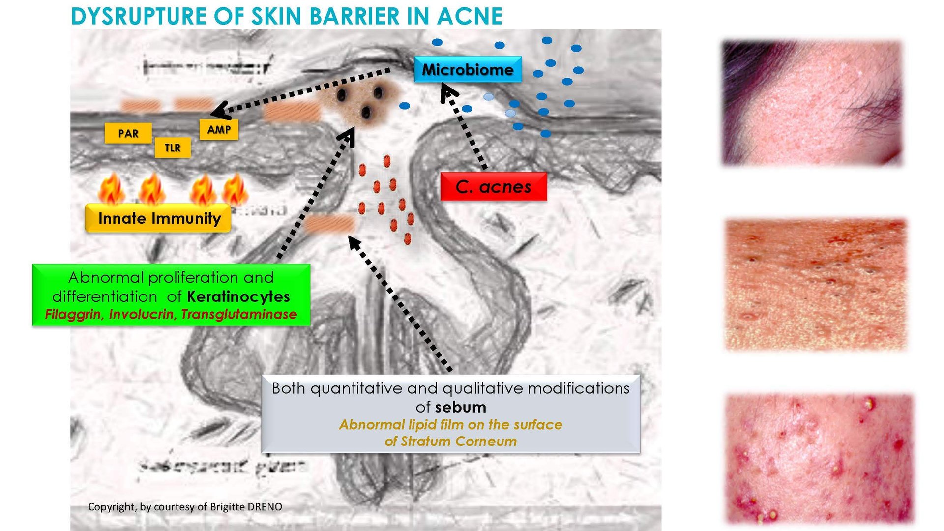 Dermocosmetics in Skin Acne and Rosacea Friend or Enemy_Page_04