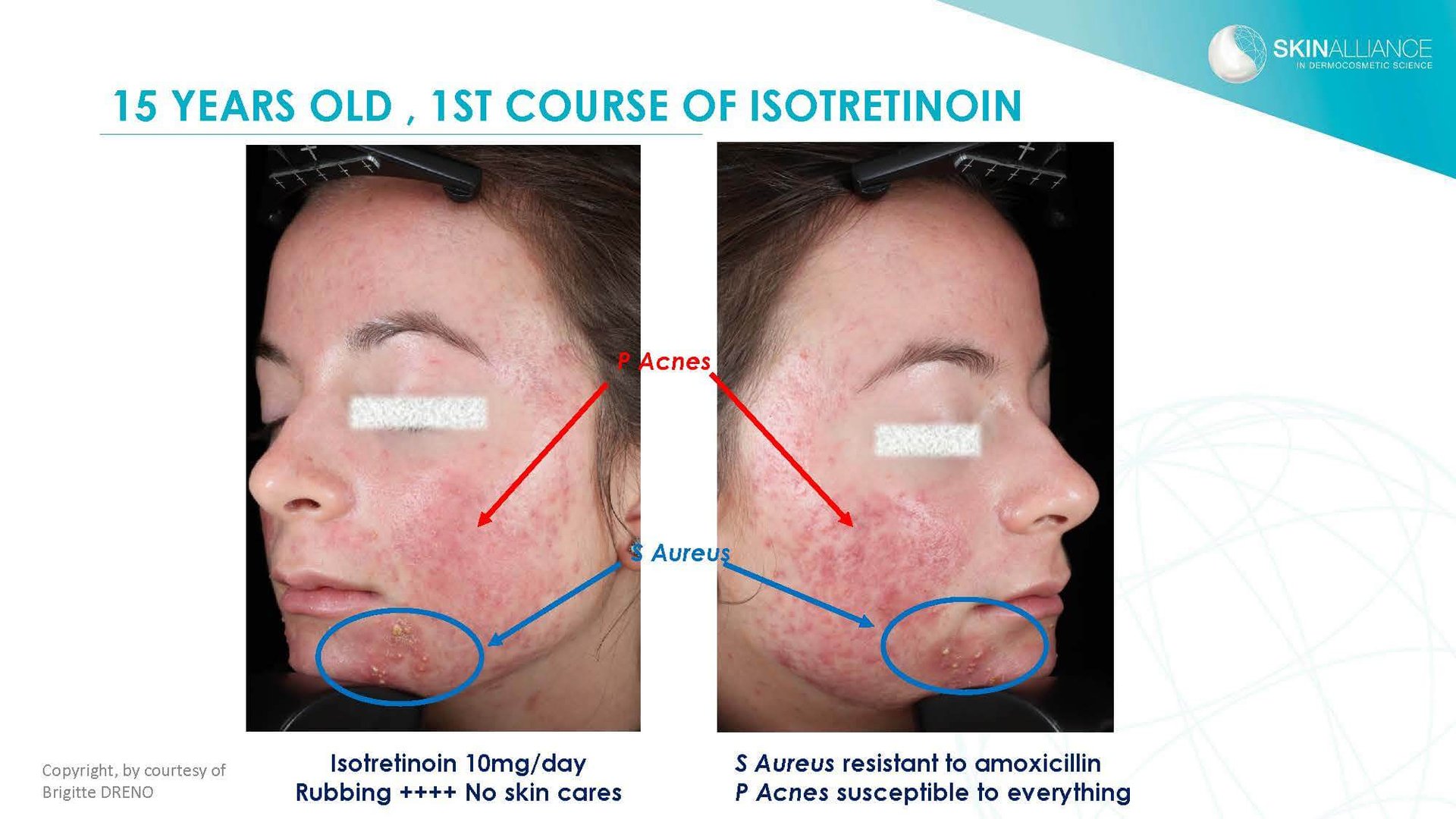 Dermocosmetics in Skin Acne and Rosacea Friend or Enemy_Page_24