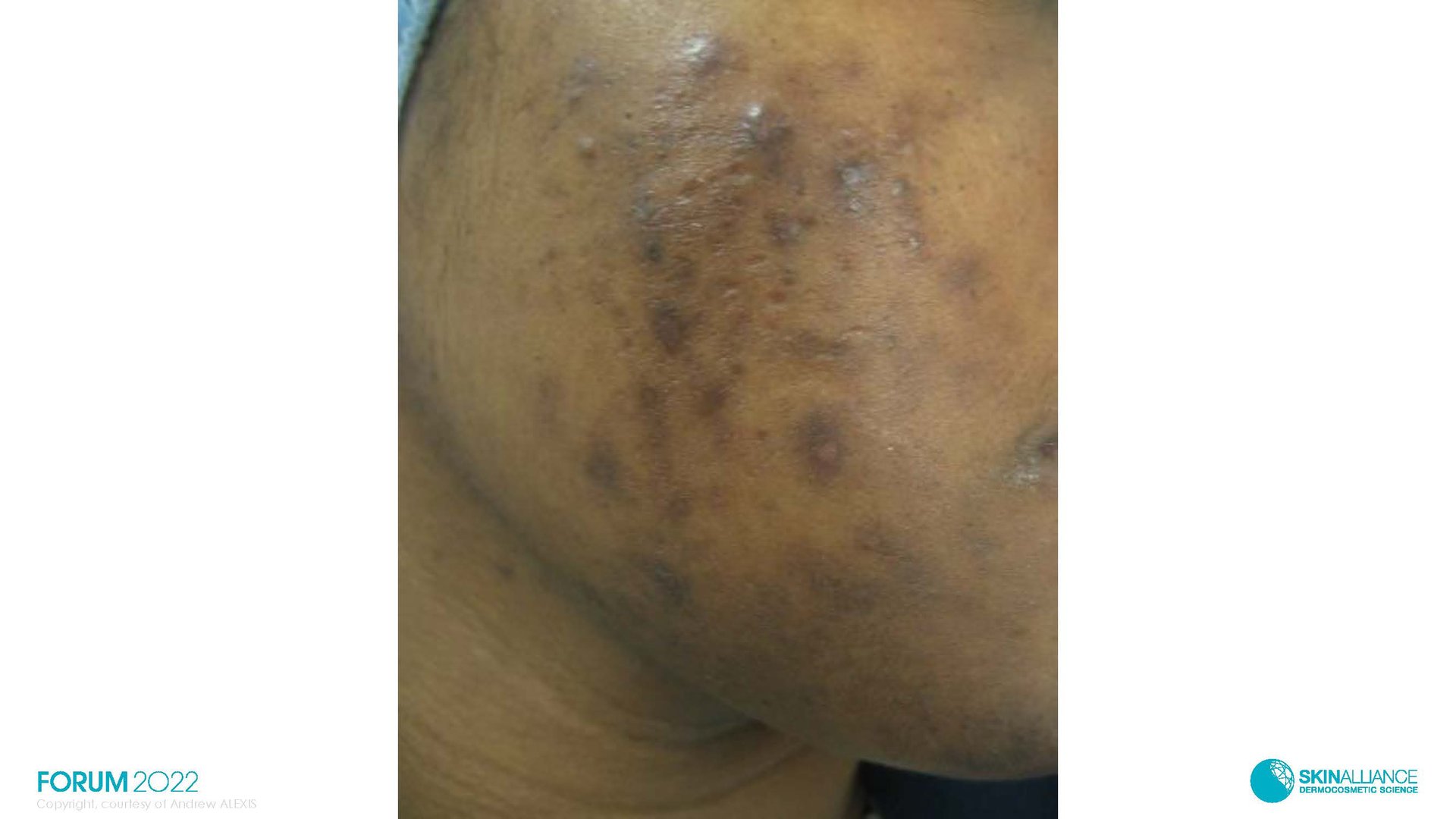 Hyperpigmentation  in Ethnic Skin
