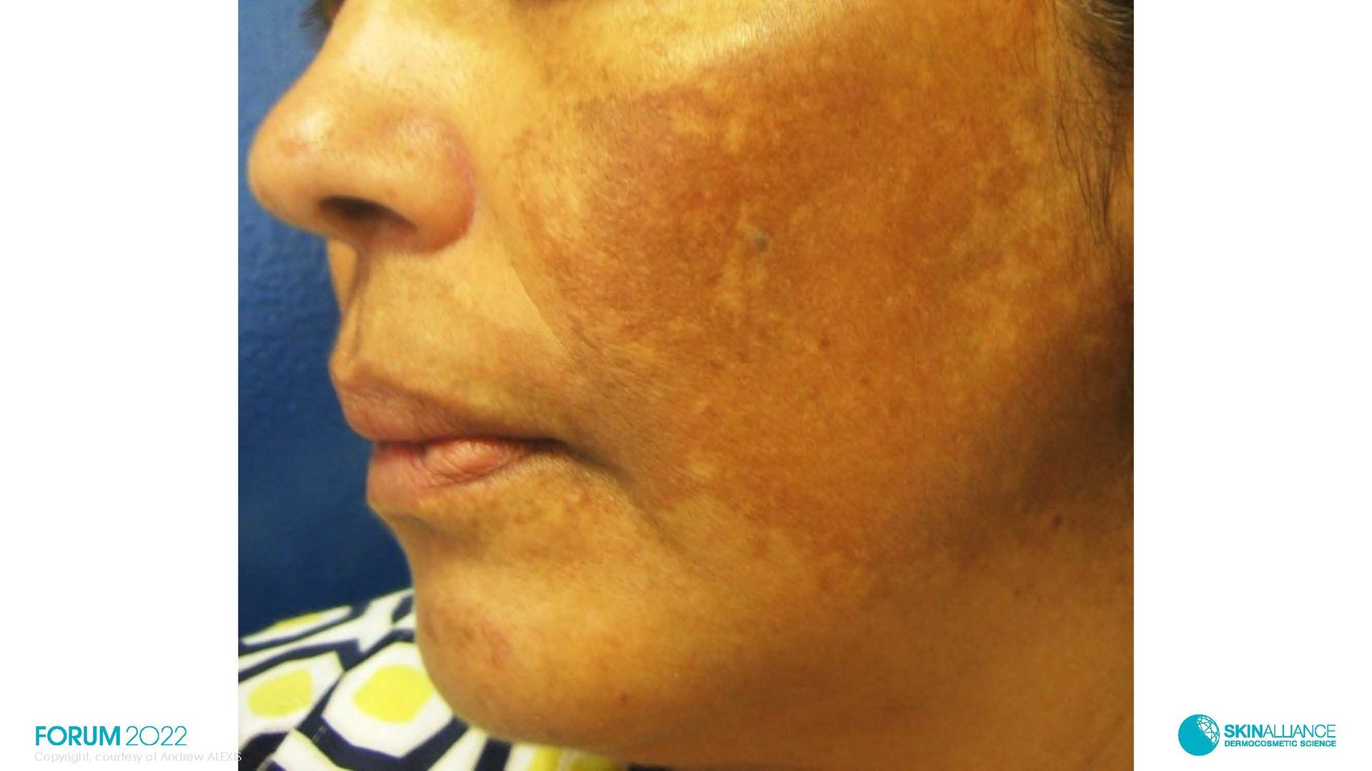 Hyperpigmentation  in Ethnic Skin