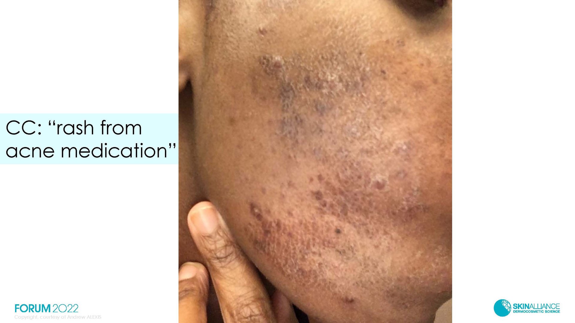 Hyperpigmentation  in Ethnic Skin