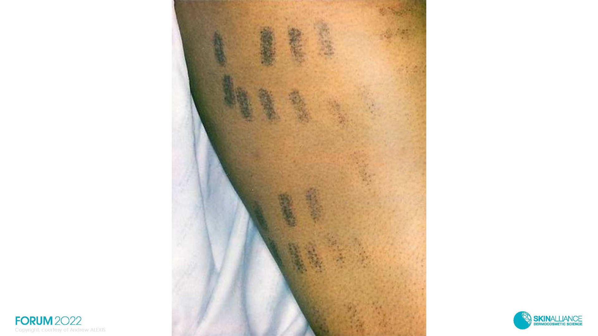 Hyperpigmentation  in Ethnic Skin