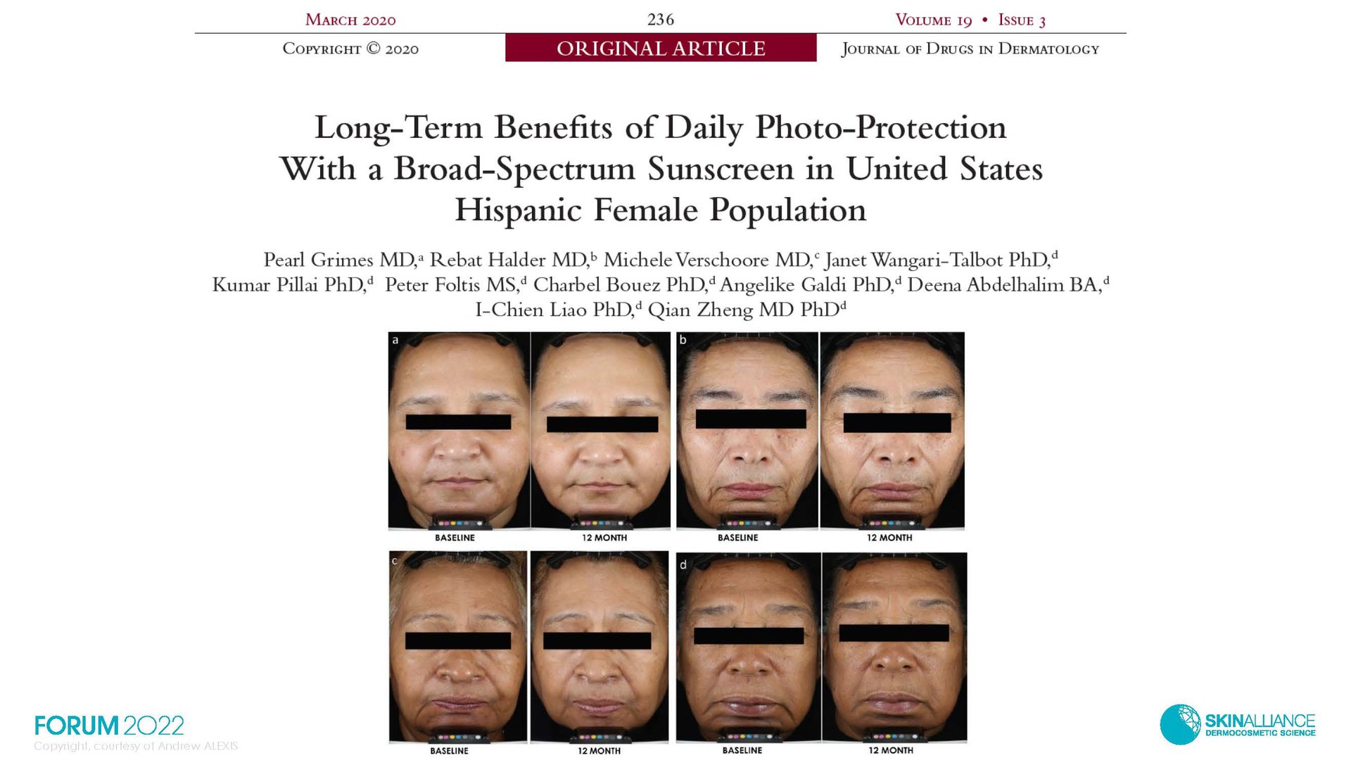 Hyperpigmentation  in Ethnic Skin