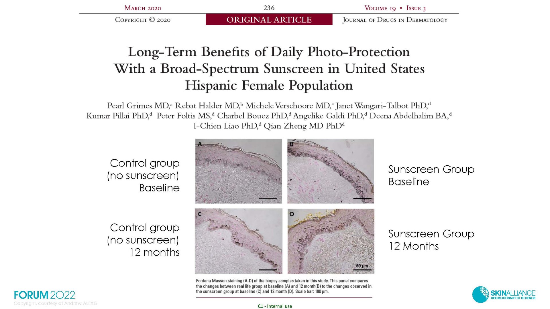 Hyperpigmentation  in Ethnic Skin
