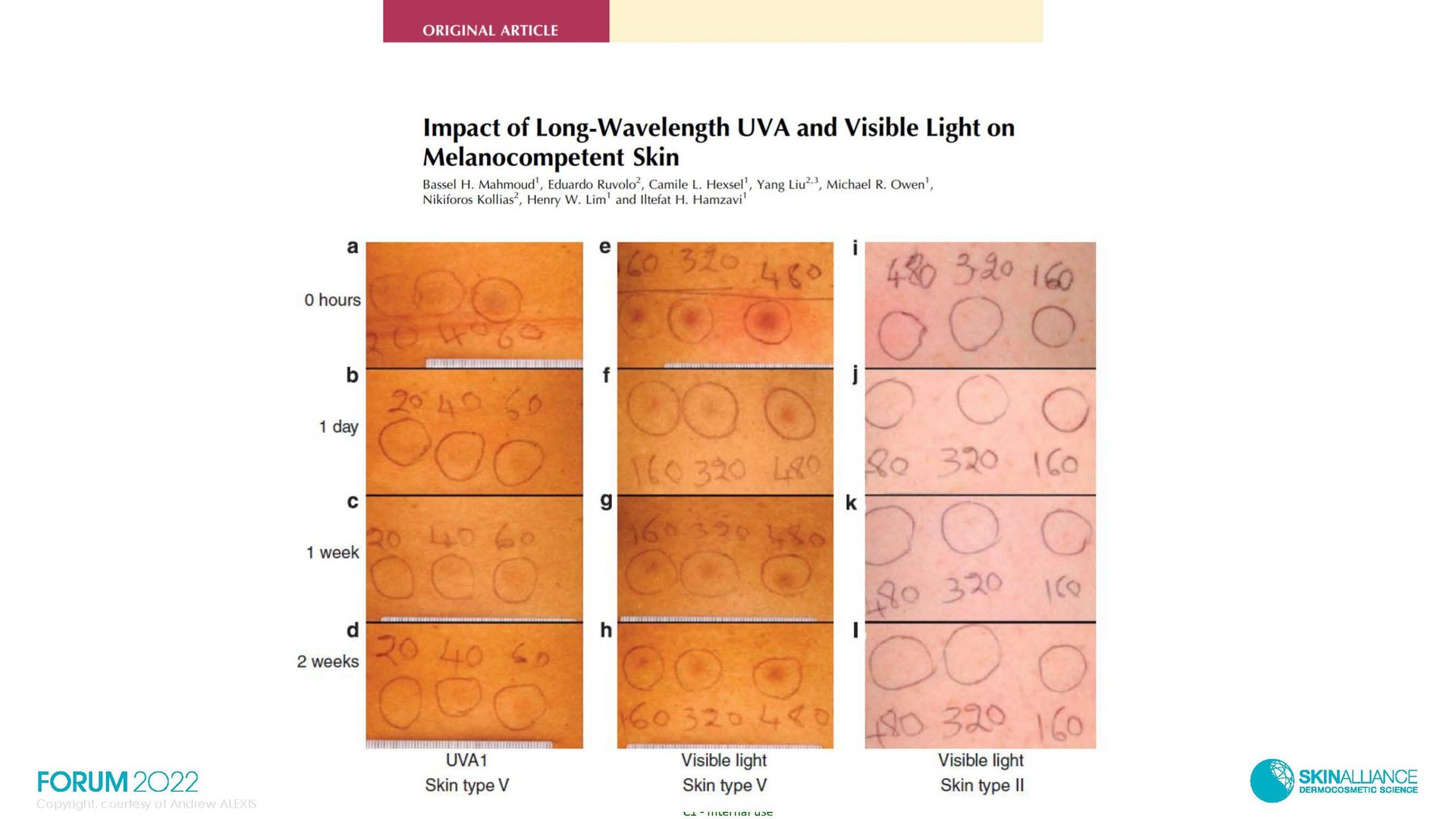 Hyperpigmentation in Ethnic Skin
