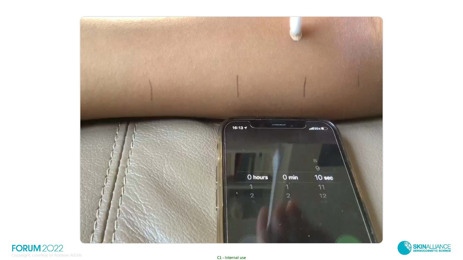 Hyperpigmentation in Ethnic Skin