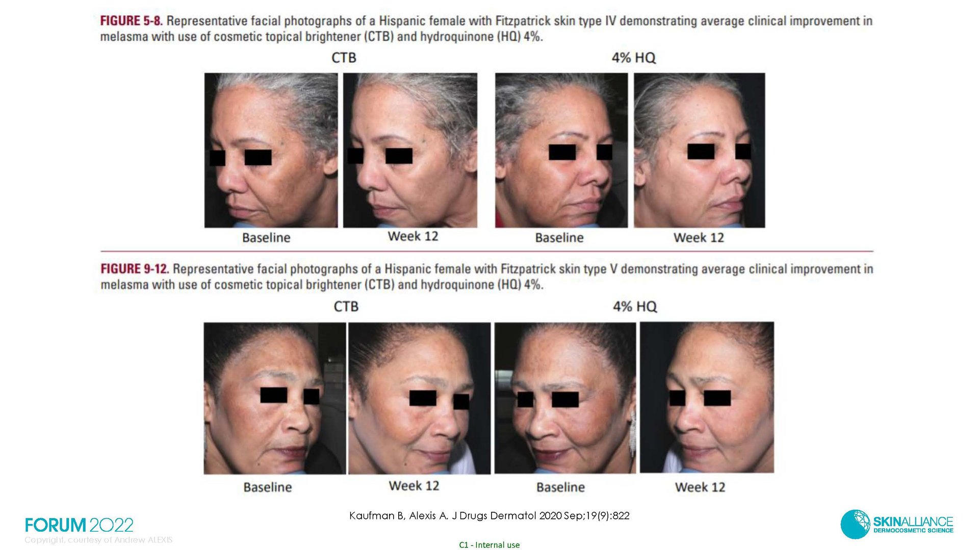 Hyperpigmentation in Ethnic Skin