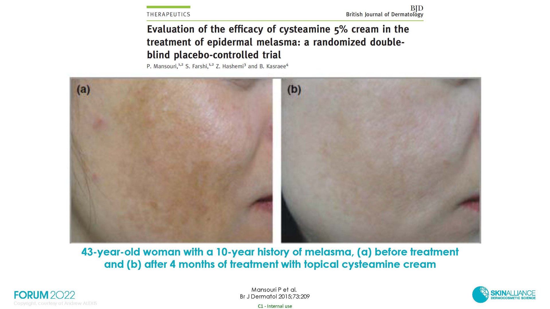 Hyperpigmentation in Ethnic Skin