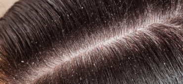 DANDRUFF MOSAIC