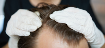 HAIR LOSS MOSAIC