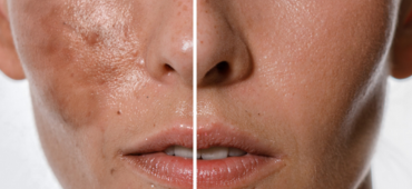 Mosaic Image Hyperpigmentation