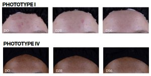 EFFACLAR DUO (+) KLINISCHE STUDIE