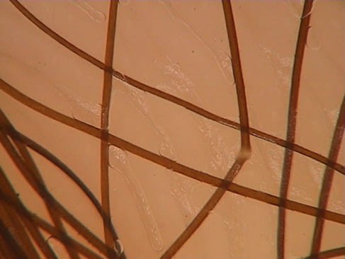 Trichorrhexis nodosa due to hair shaft traumatic damage