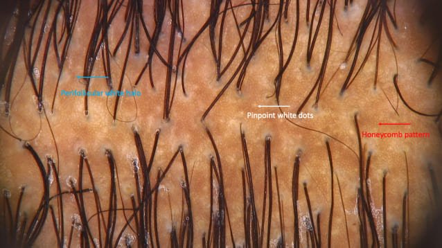 The normal black scalp
